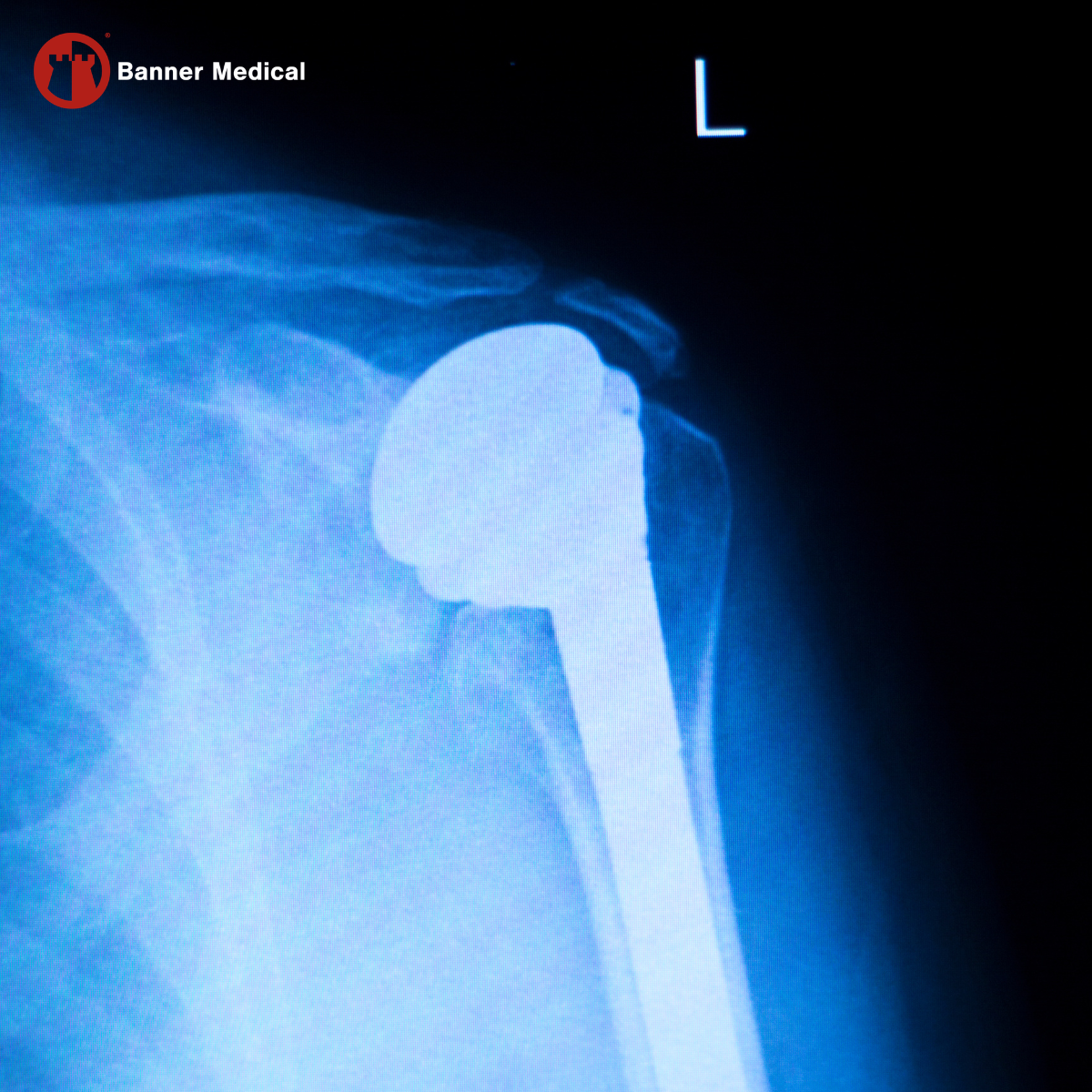 Titanium Bar for Orthopedic Implant Manufacturing in Minneapolis, Minnesota 