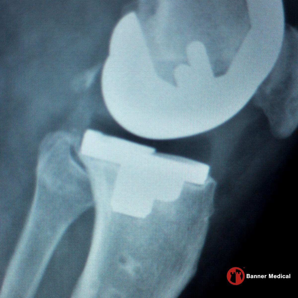 Titanium alloy bar prepared for orthopedic implant manufacturing in Memphis, Tennessee 