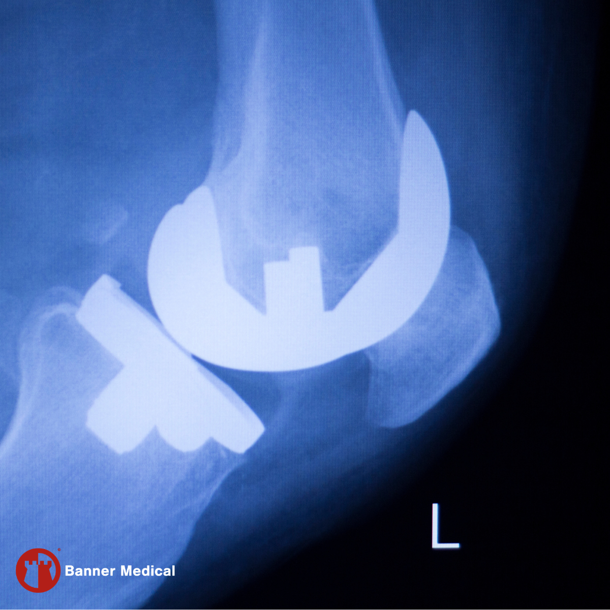 Medical-grade titanium bar prepared for orthopedic implant manufacturing